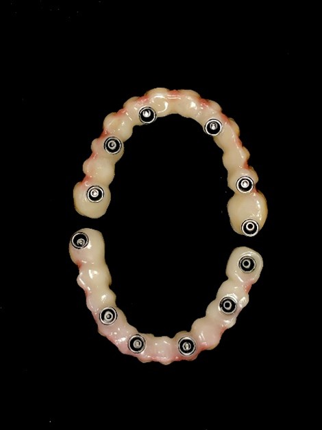 Implantatgetragene Zahnbrücke mit mehreren Befestigungspunkten