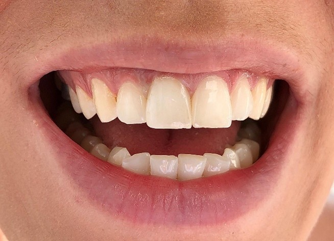 Nahaufnahme eines geöffneten Mundes mit natürlichen Zähnen