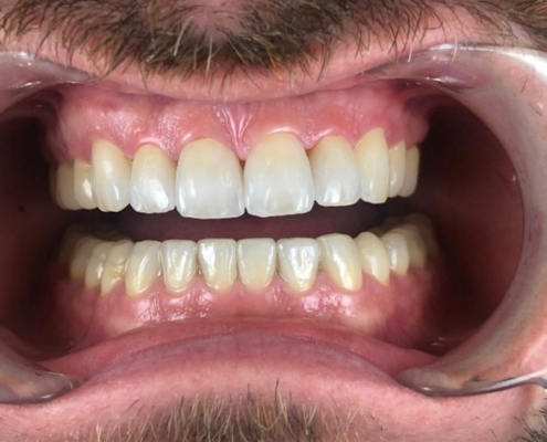 Nahaufnahme eines geöffneten Mundes nach Veneer-Behandlung