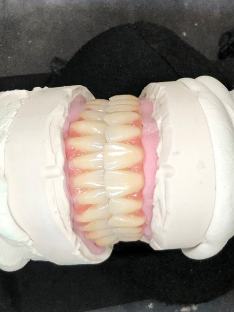 Zahntechnische Anfertigung einer Vollprothese